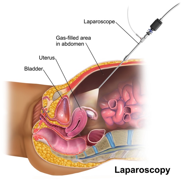 Risks in Laparoscopy